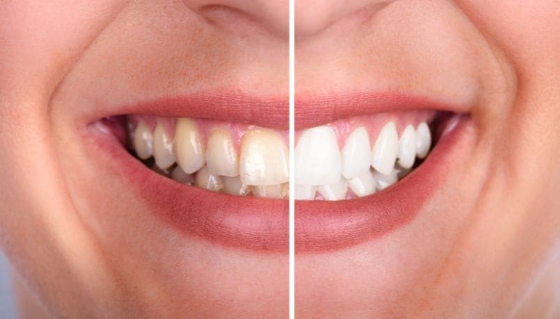 Teeth whitening treatment